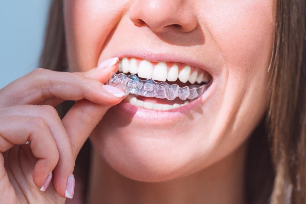 What Happens During Invisalign Treatment from Consultation to Retainers in Delhi