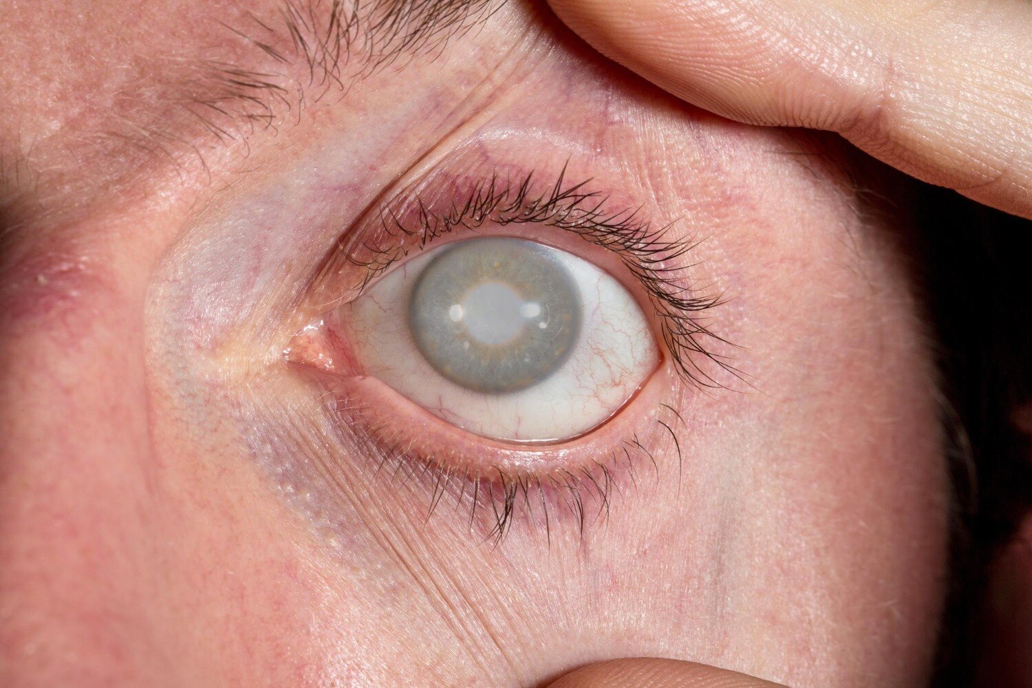 When Blurred Vision and Glare May Be Signs You Should Consult a Cataract Surgeon