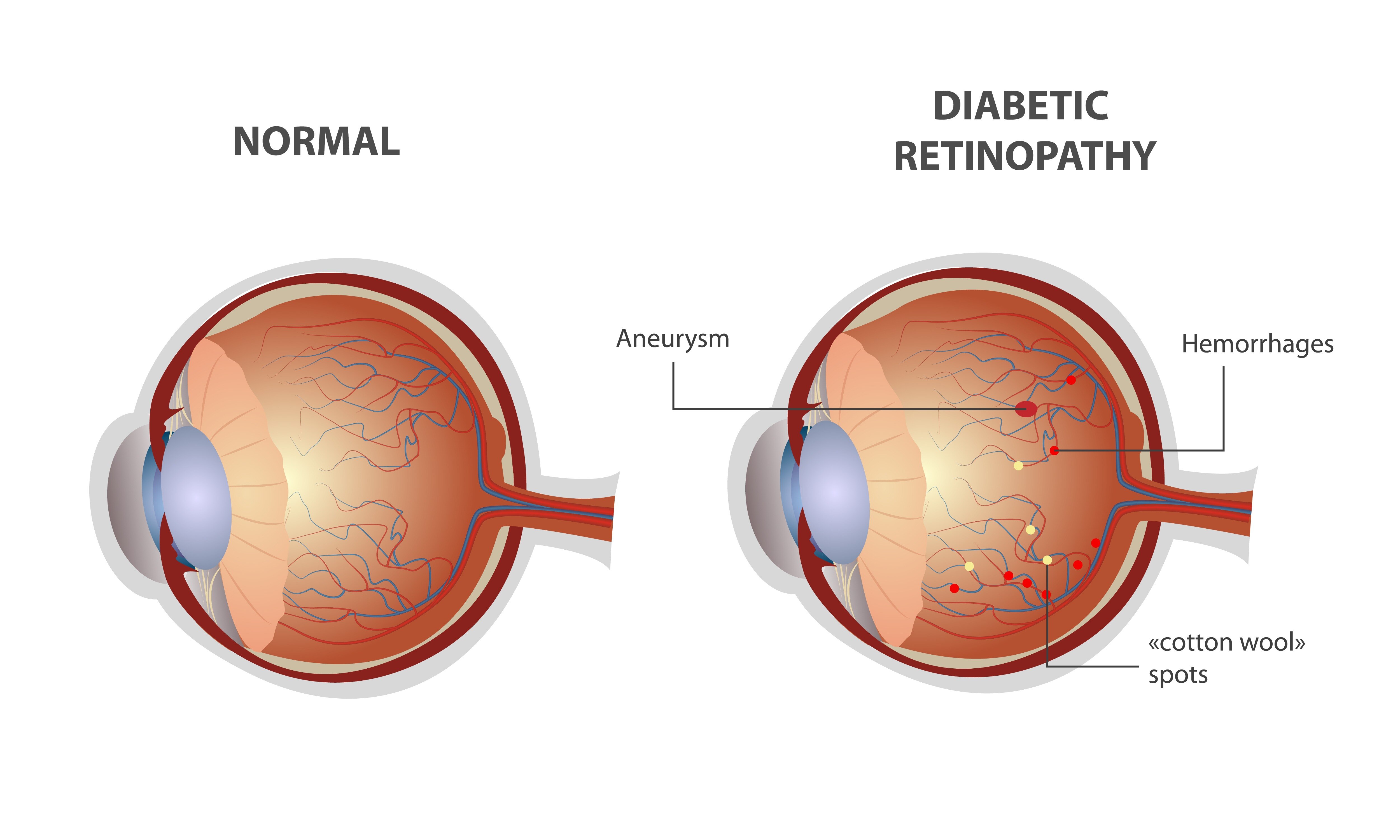 How Diabetic Retinopathy Can Affect Vision and Why Regular Retina Checkups Matter