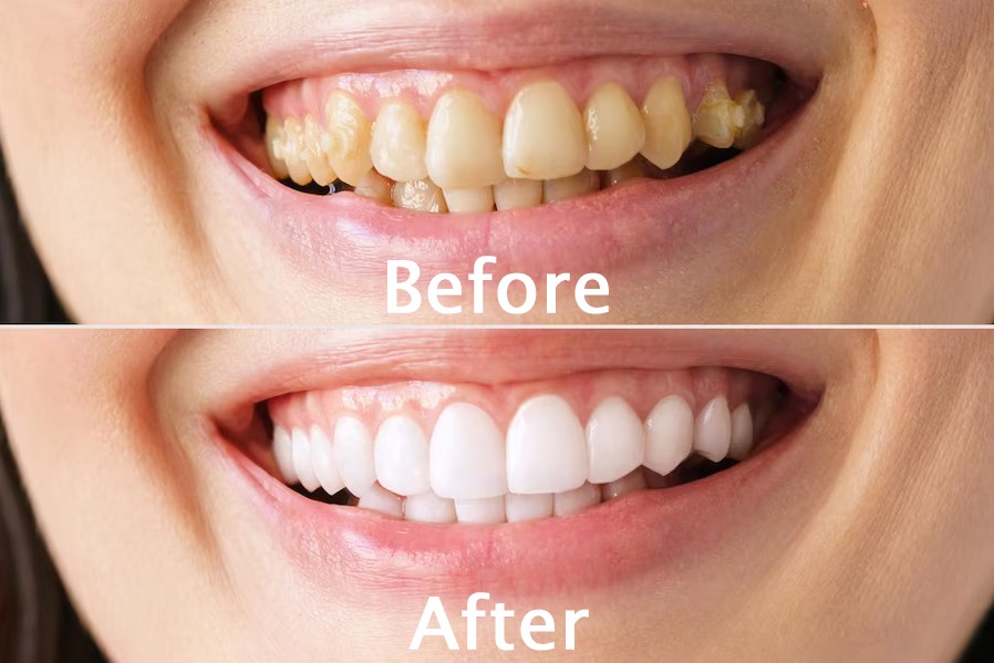Best scaling/cleaning of teeth treatment