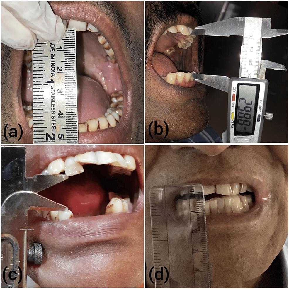 Oral Submucous Fibrosis Assessment Near Marunji | Wakad