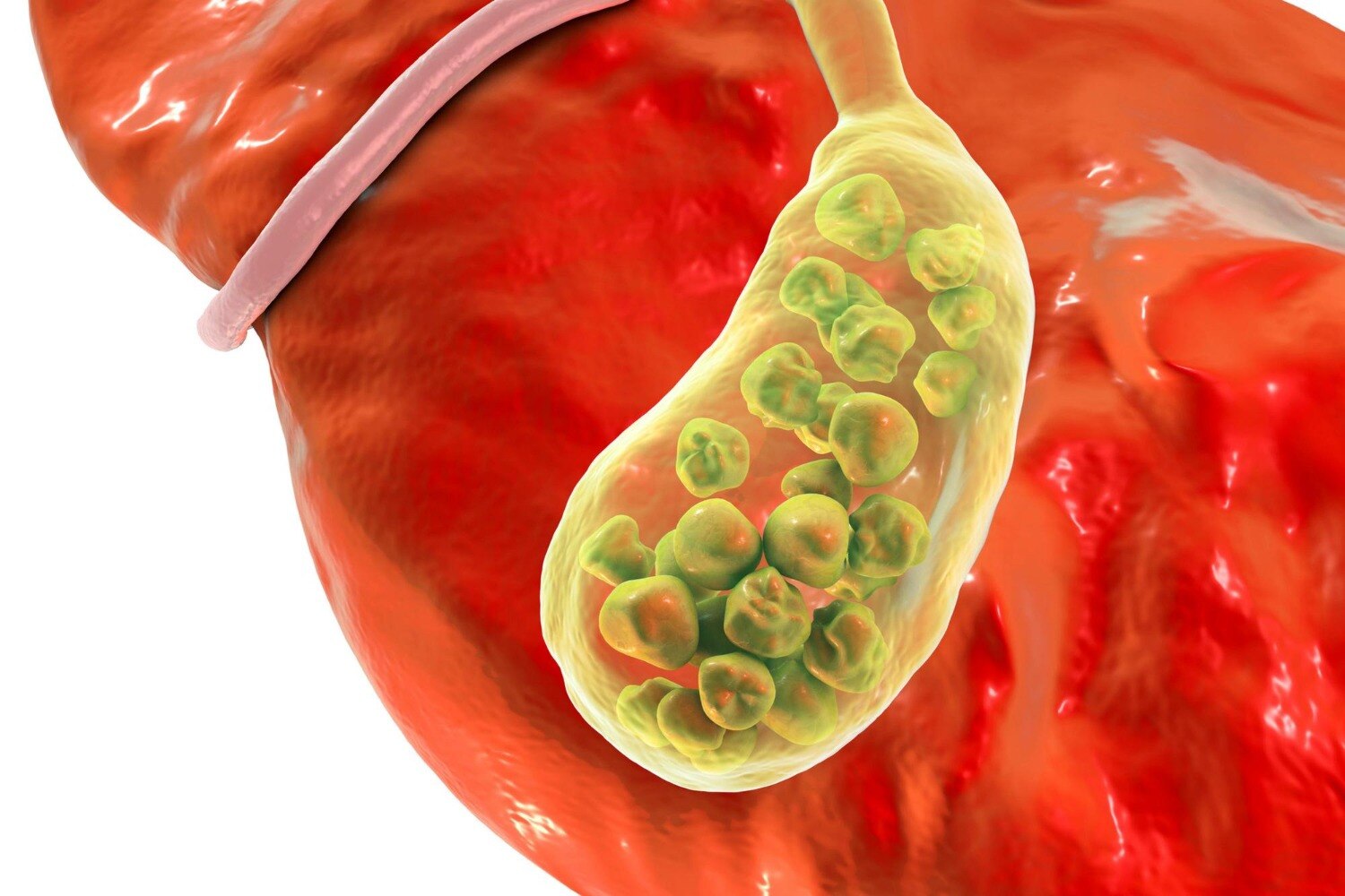 Recurring Upper Abdominal Pain and When Gall Bladder Stone Treatment May Be Needed