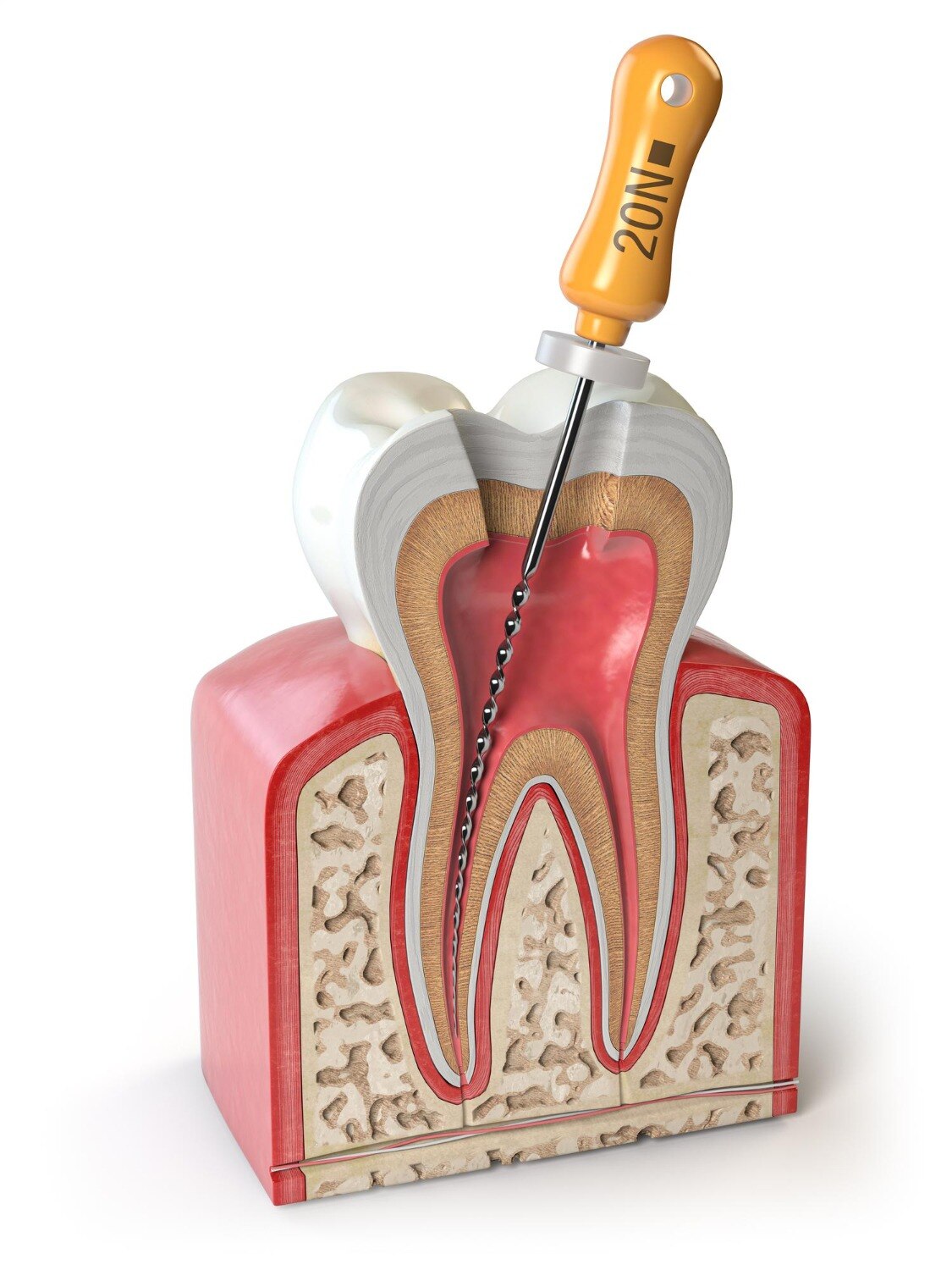 Severe Toothache and Infection: When Root Canal Treatment May Help Save the Tooth