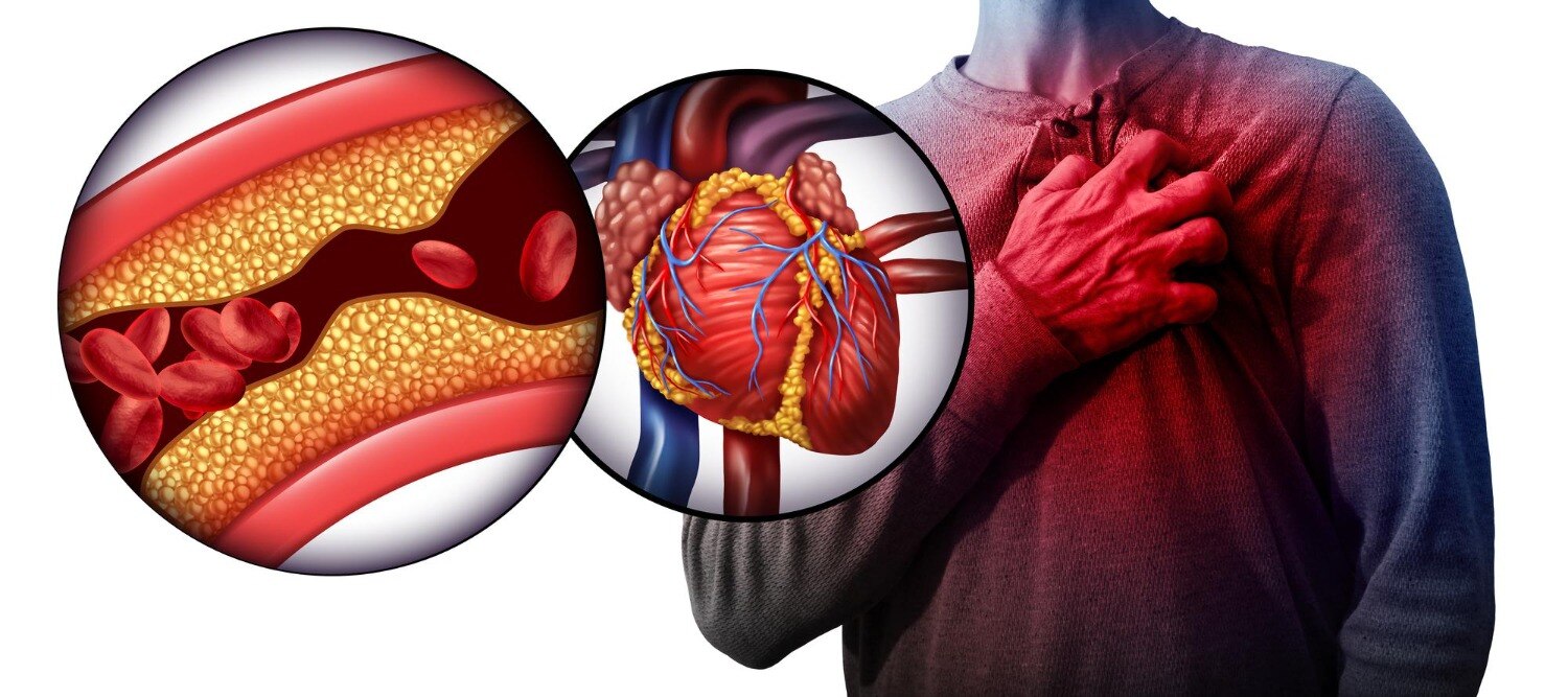 Blocked Arteries Treatment in Belapur for Better Heart Blood Flow