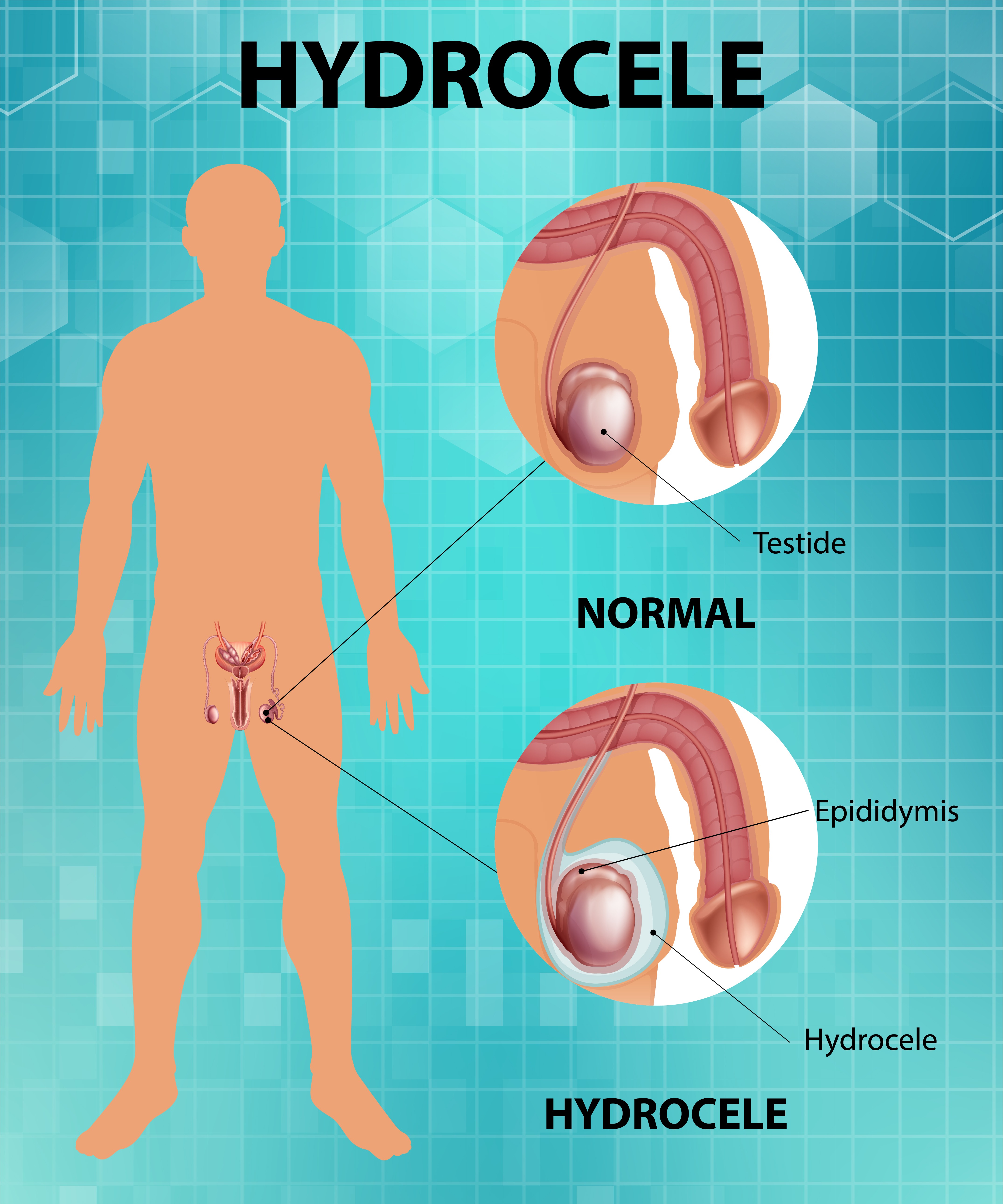 Hydrocele Surgery in Dadar: How to Know When Surgical Treatment May Be Appropriate