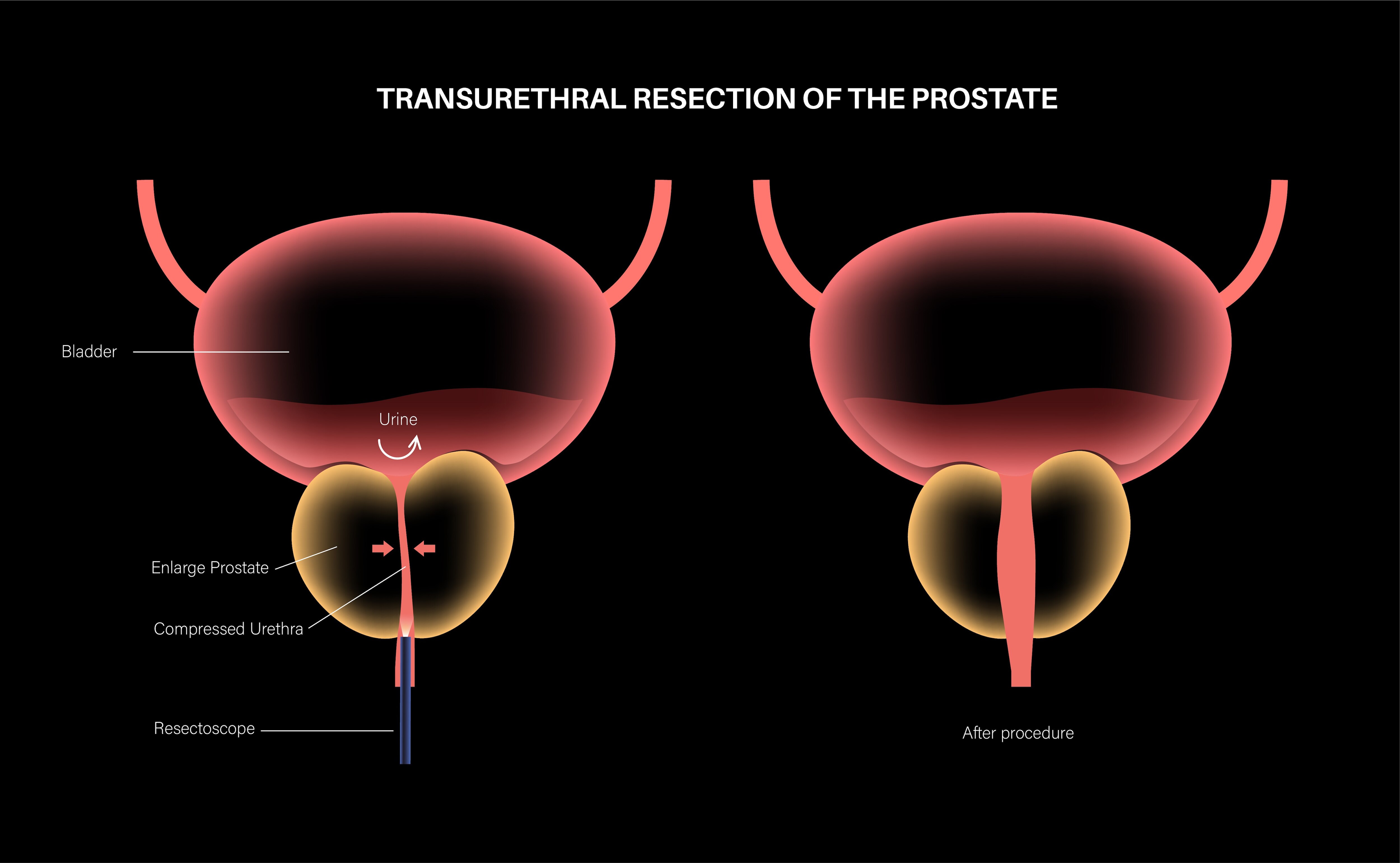 When TURP May Be Recommended for Urinary Problems Caused by an Enlarged Prostate