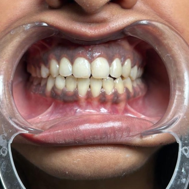 Does Scaling Really Damage Your Teeth? Myths vs Facts