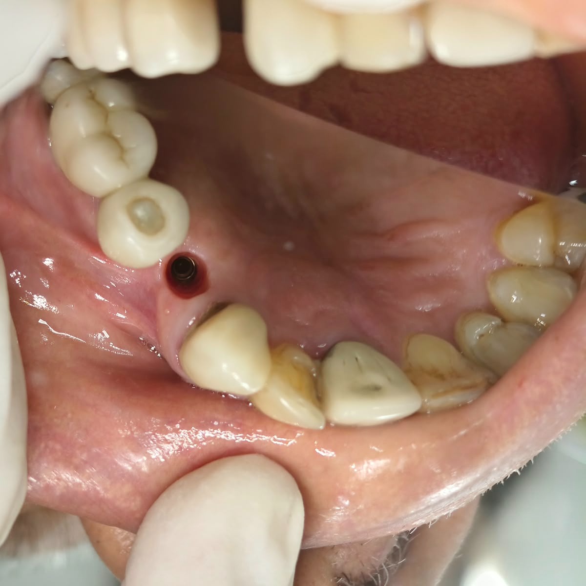 Dental Implant Healing Time: How Long Does It Take for an Implant to Heal Completely?