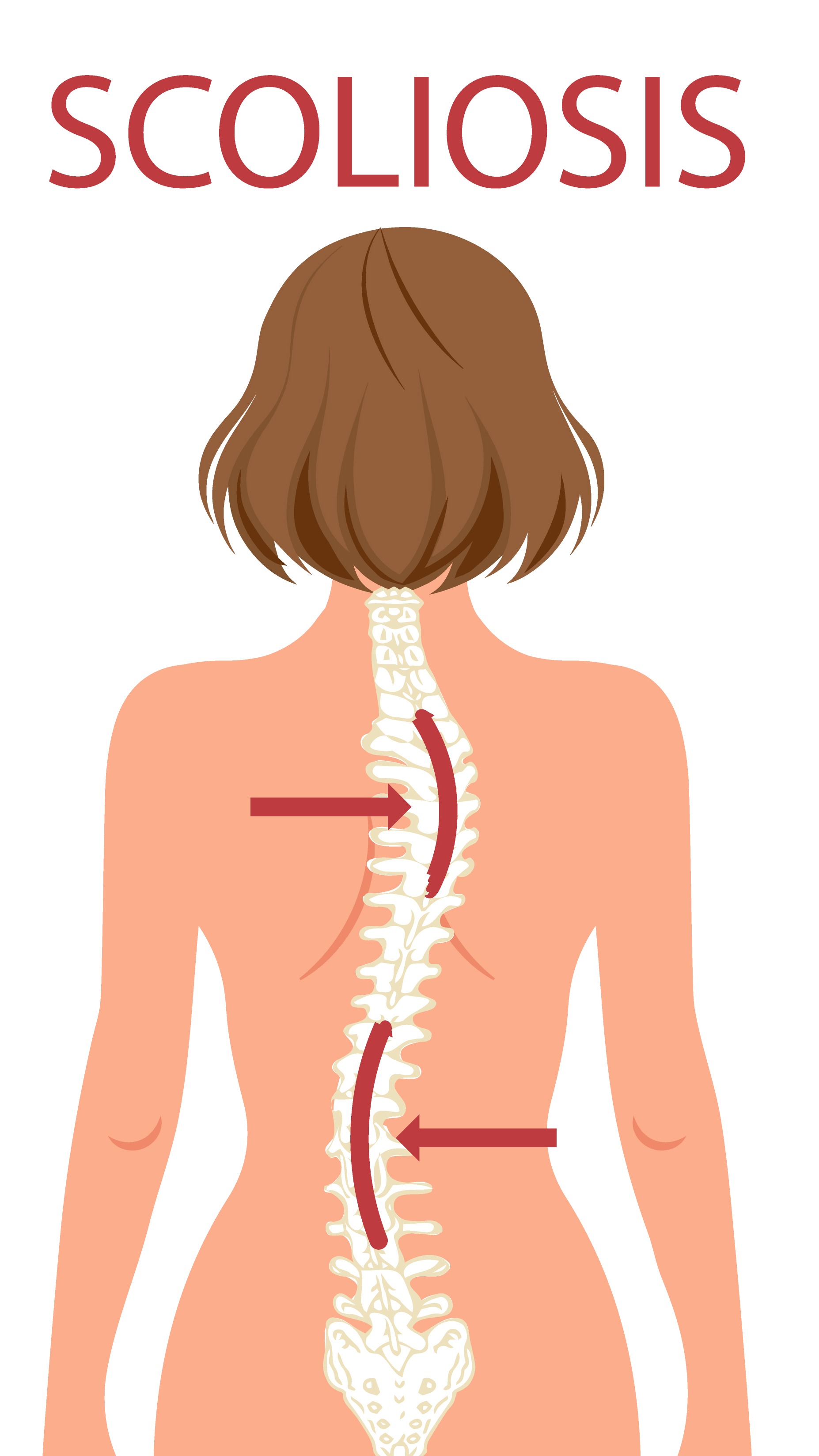 What Patients Should Know Before Considering Scoliosis Correction