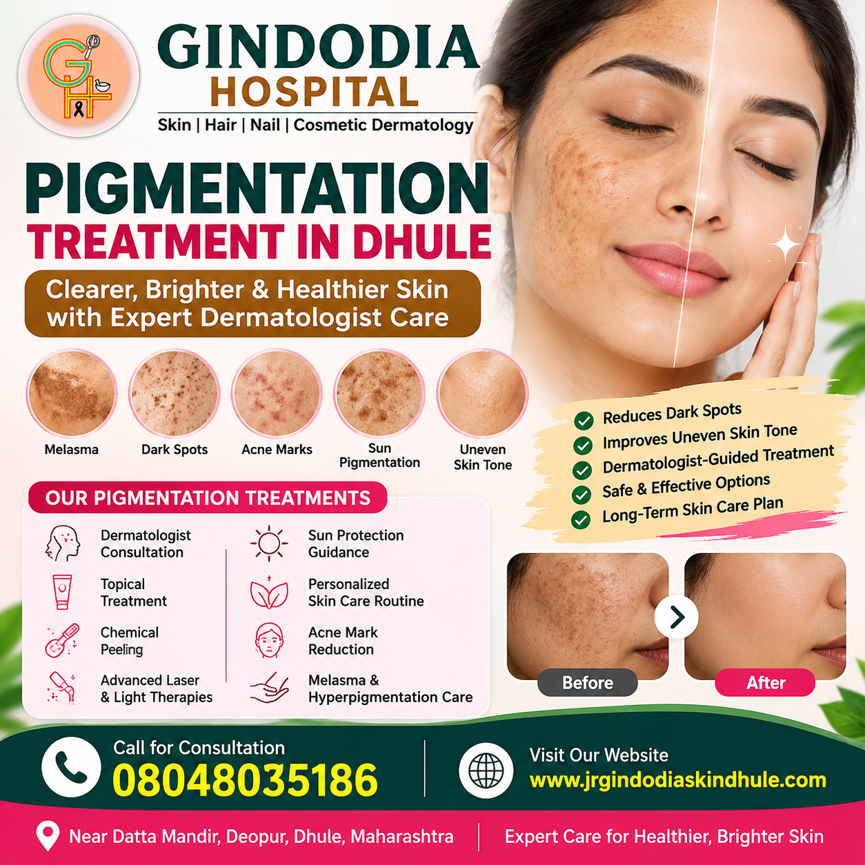 Pigmentation Treatment in Dhule | Gindodia Hospital