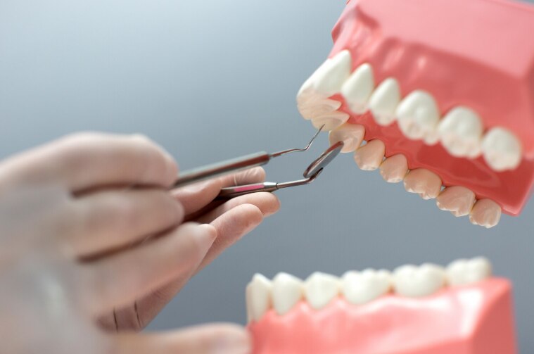 How to Choose Between Dental Crowns and Bridges