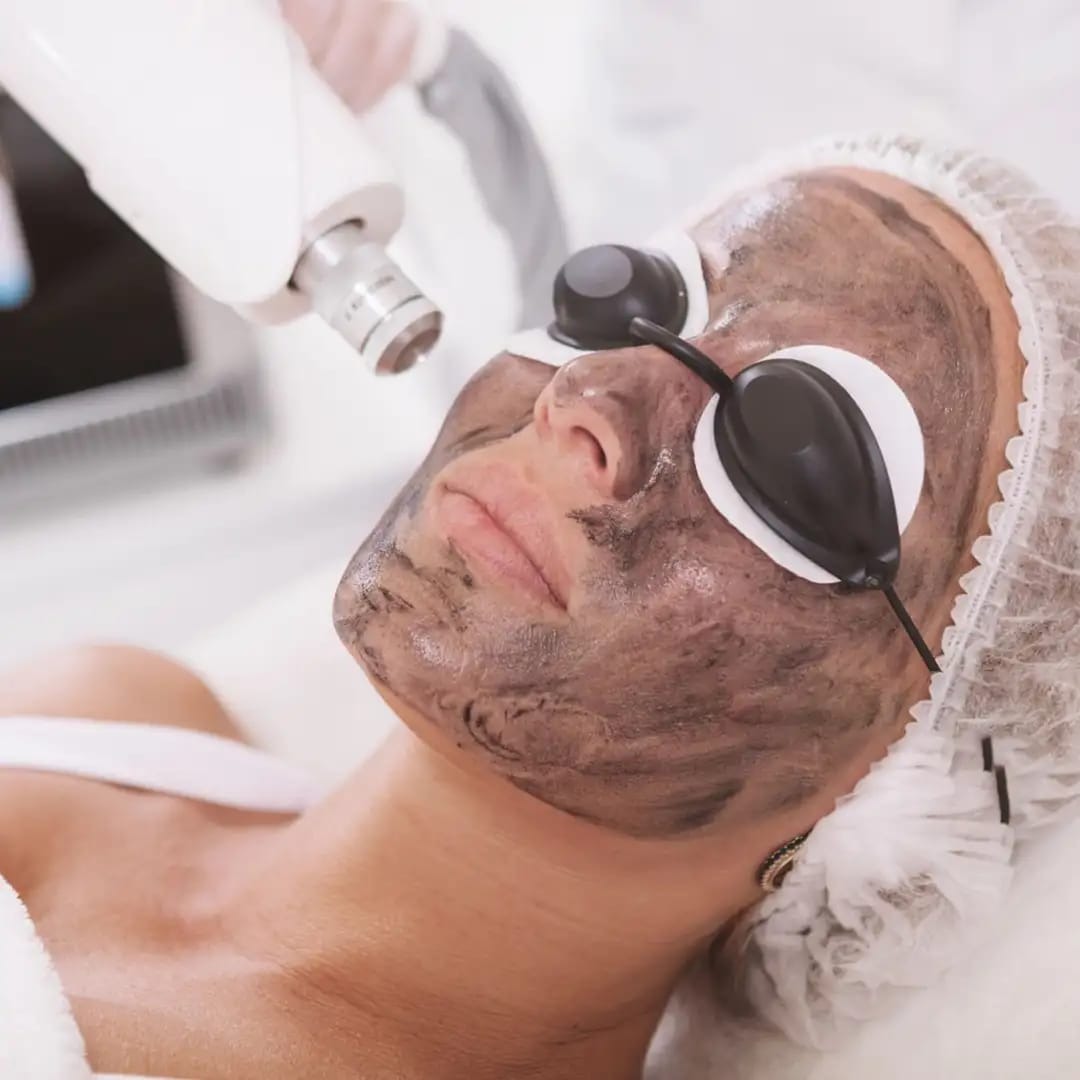 Best carbon peel laser treatment in vashi