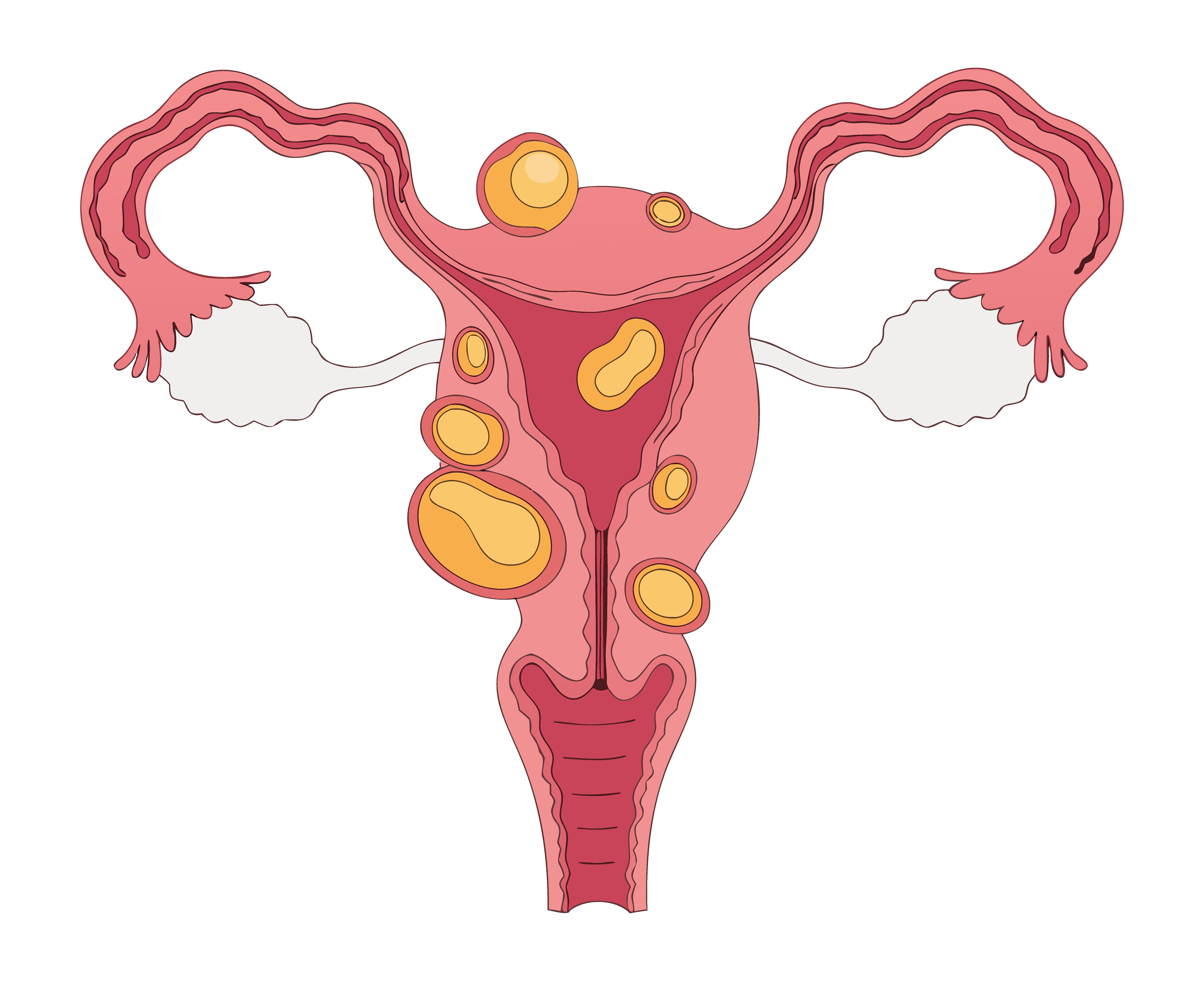 What to Ask Before Booking a Hysterectomy in Mumbai