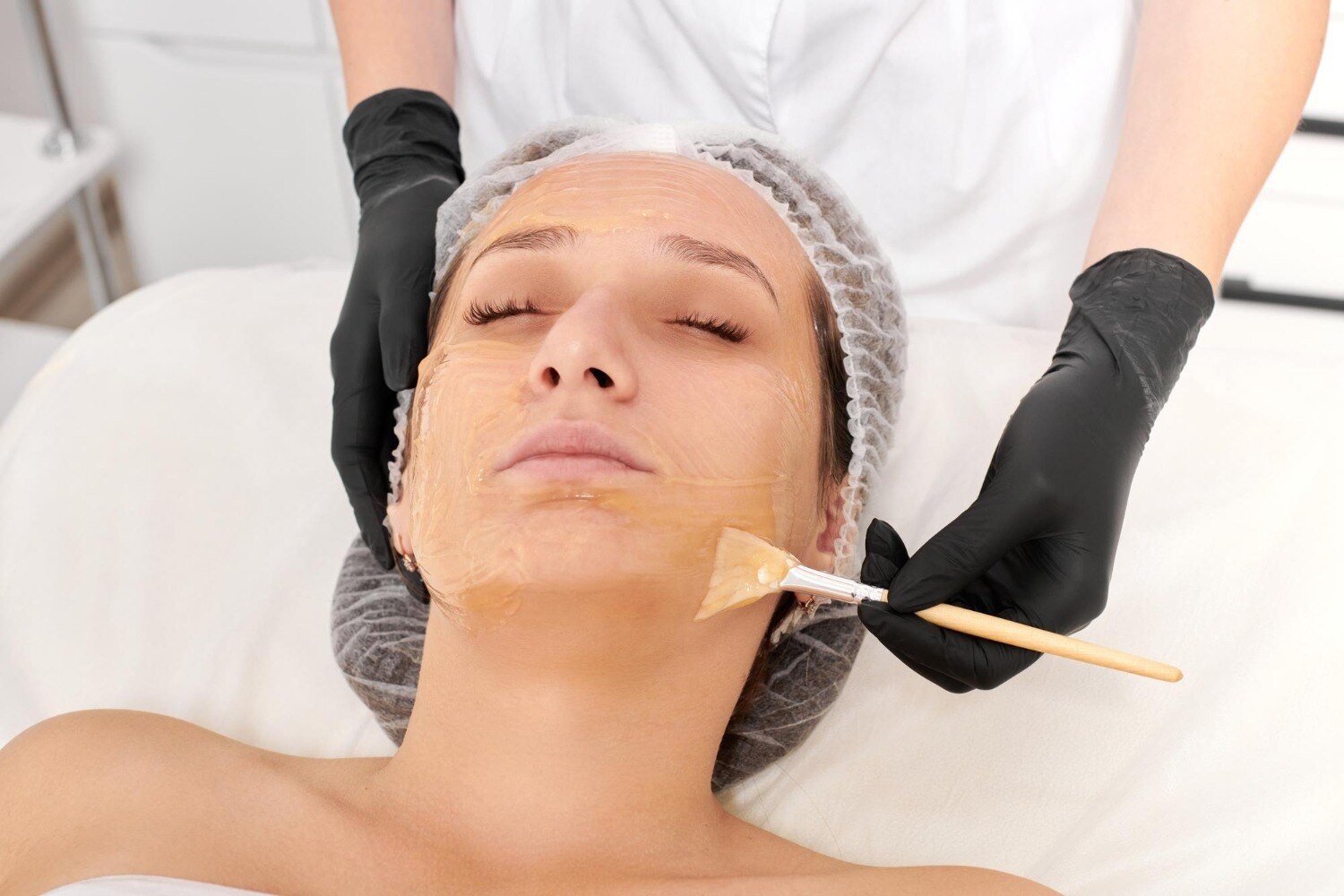 Chemical Peel or Other Care for Pigmentation in Hinjewadi
