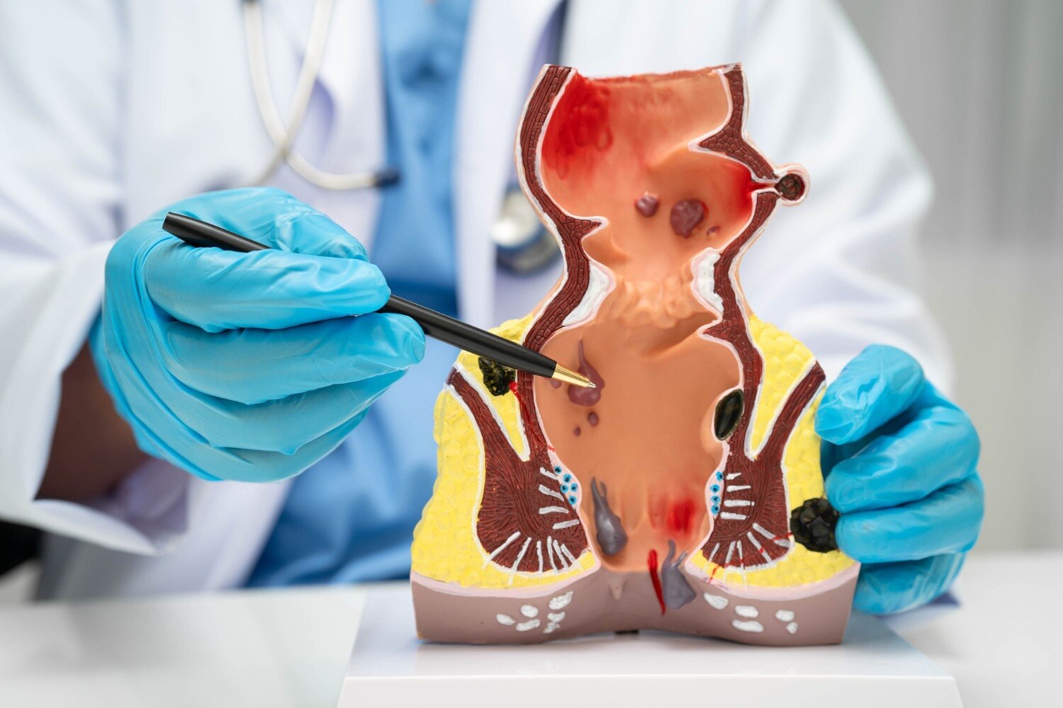 When Persistent Discharge or Swelling Near the Anus May Require Fistula Treatment