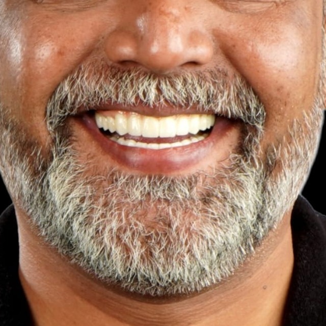Why Do Some Smile Makeovers Look Artificial?