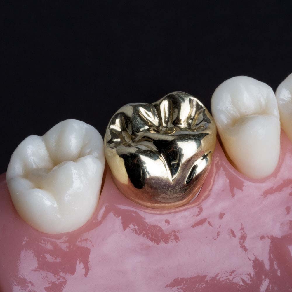 Best full metal crowns treatment in vashi