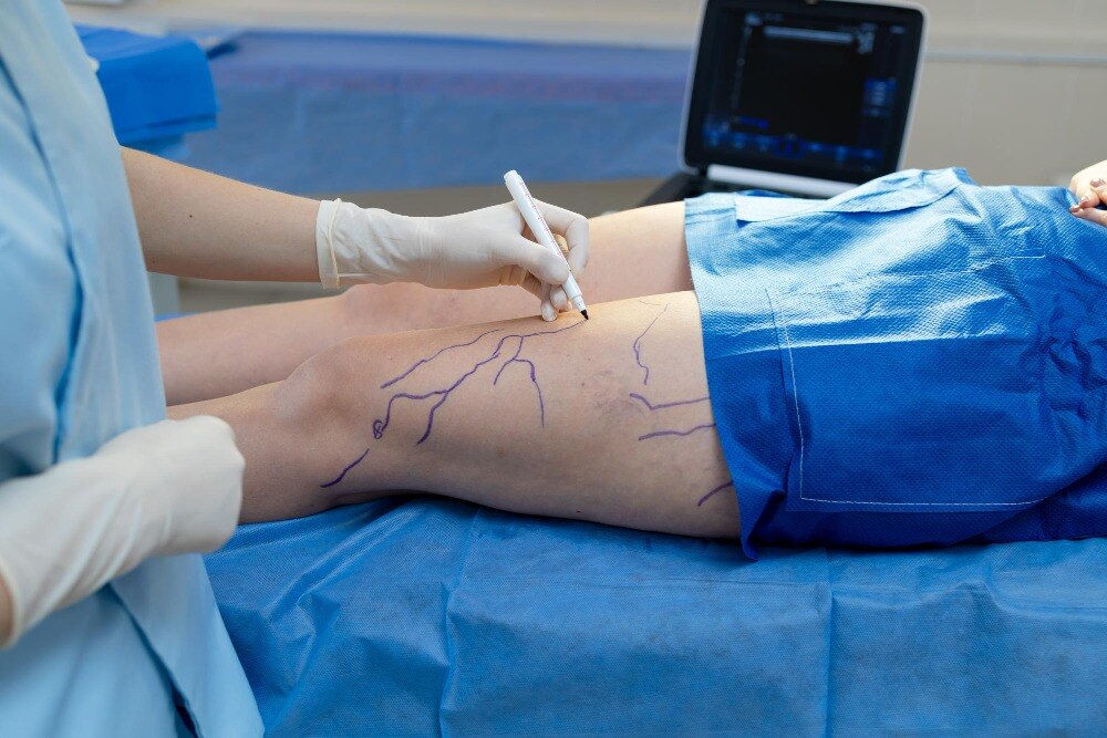 Lower Limb Angioplasty for Restoring Blood Flow in the Legs