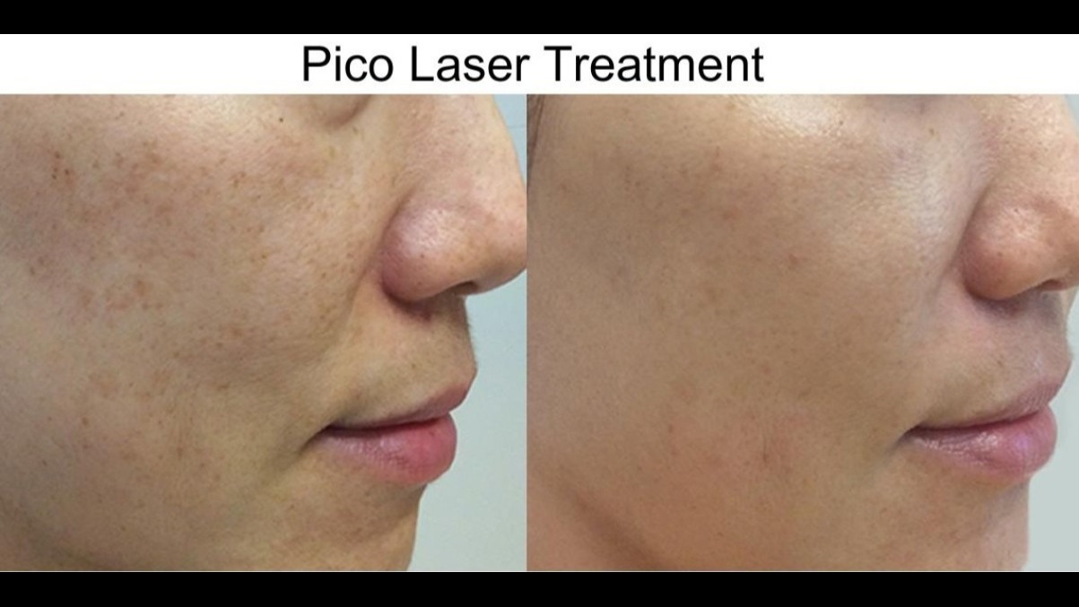 Pico laser treatment at Rakesh Reddy's skin clinic conveniently located in Sanjay Nagar, Hebbal, Ben