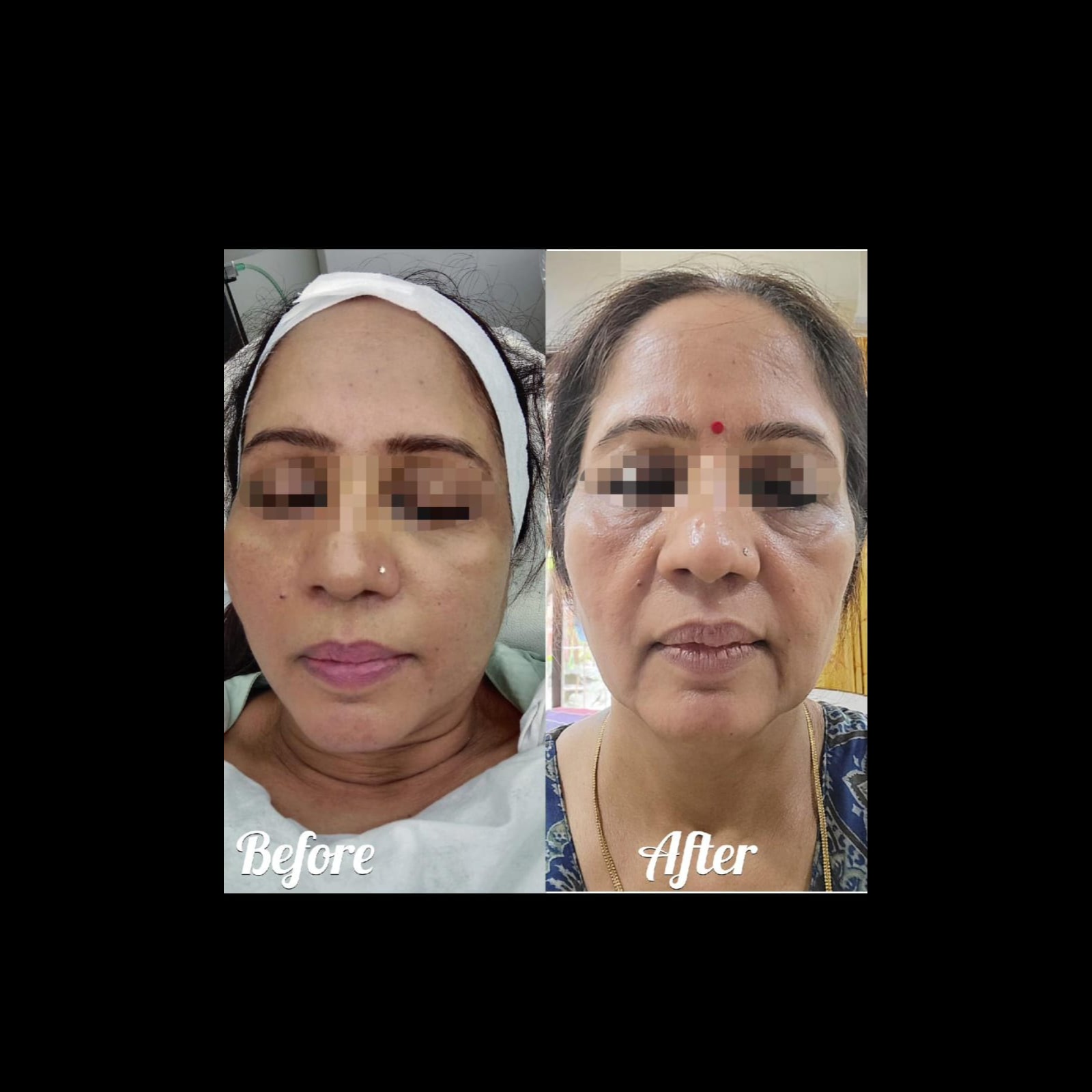 DR MESO PEN TREATMENT COMBINED WITH EXOSOMES IN Vashi