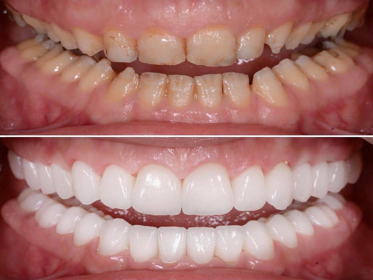 Full Mouth rehabilitation In Vashi