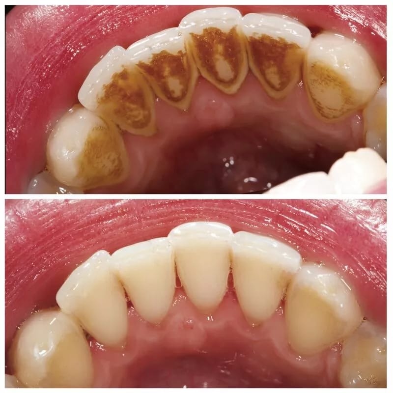 Best Tooth cleaning in vashi