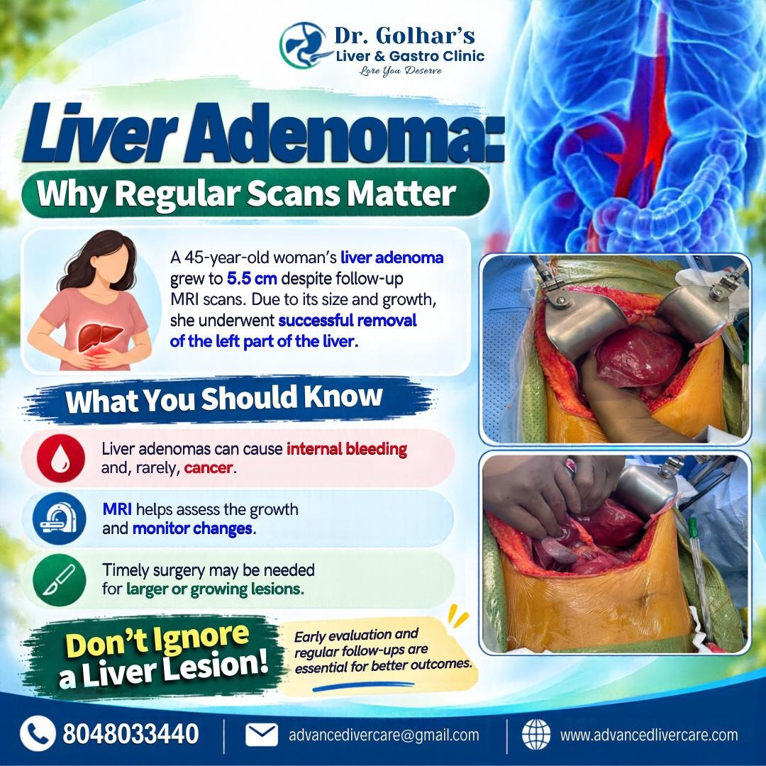 Liver Adenoma: Why Regular Scans Matter