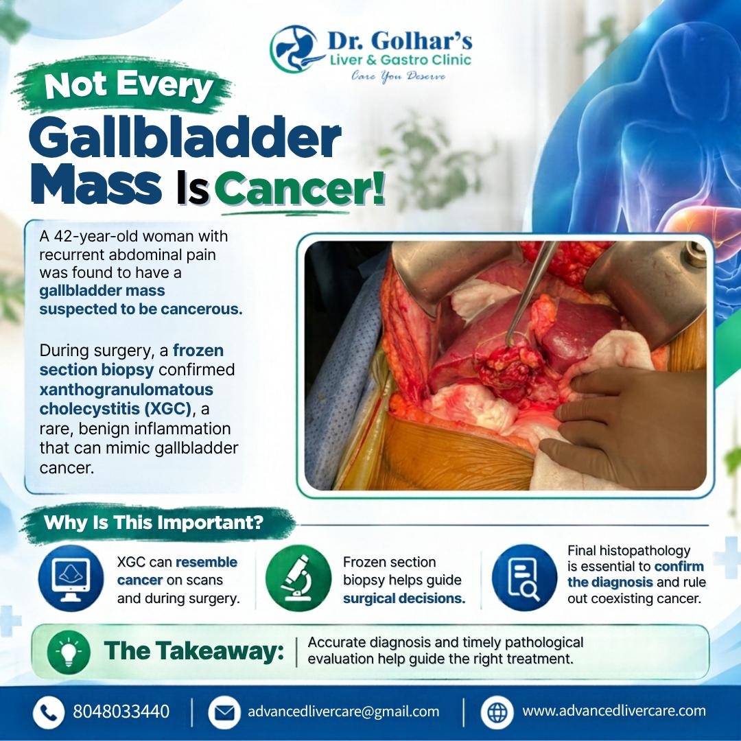 Gallbladder Specialist in Mumbai | Accurate Diagnosis Matters
Not Every Gallbladder Mass Is Cancer
...