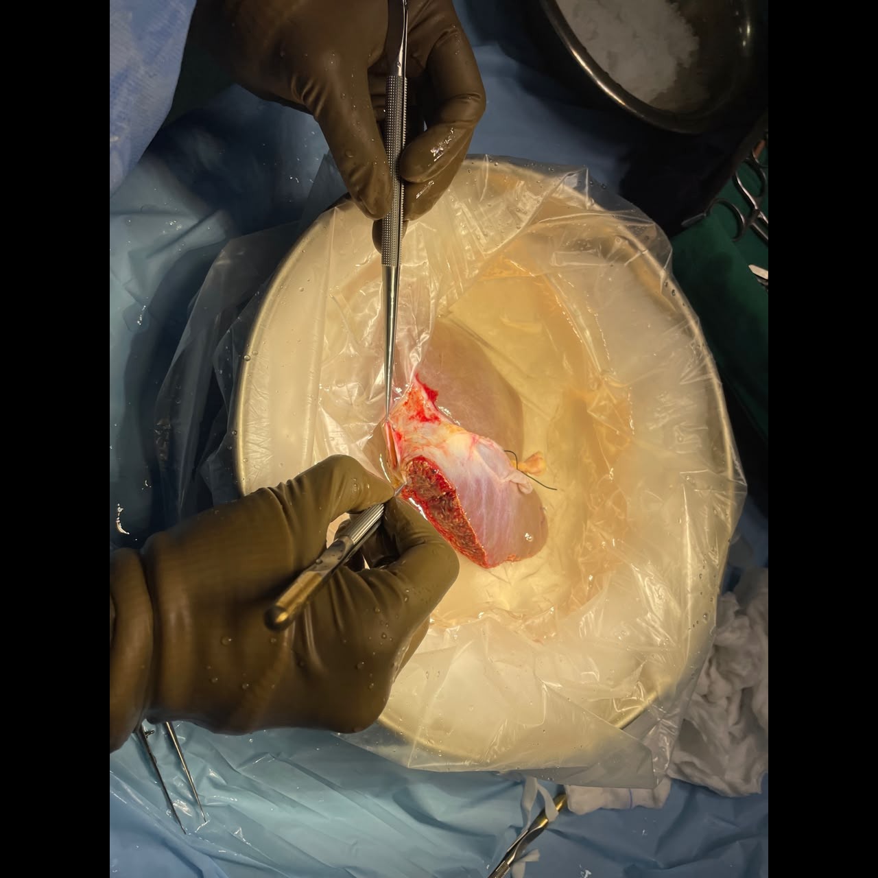A split cadaver Liver Transplant in Mumbai