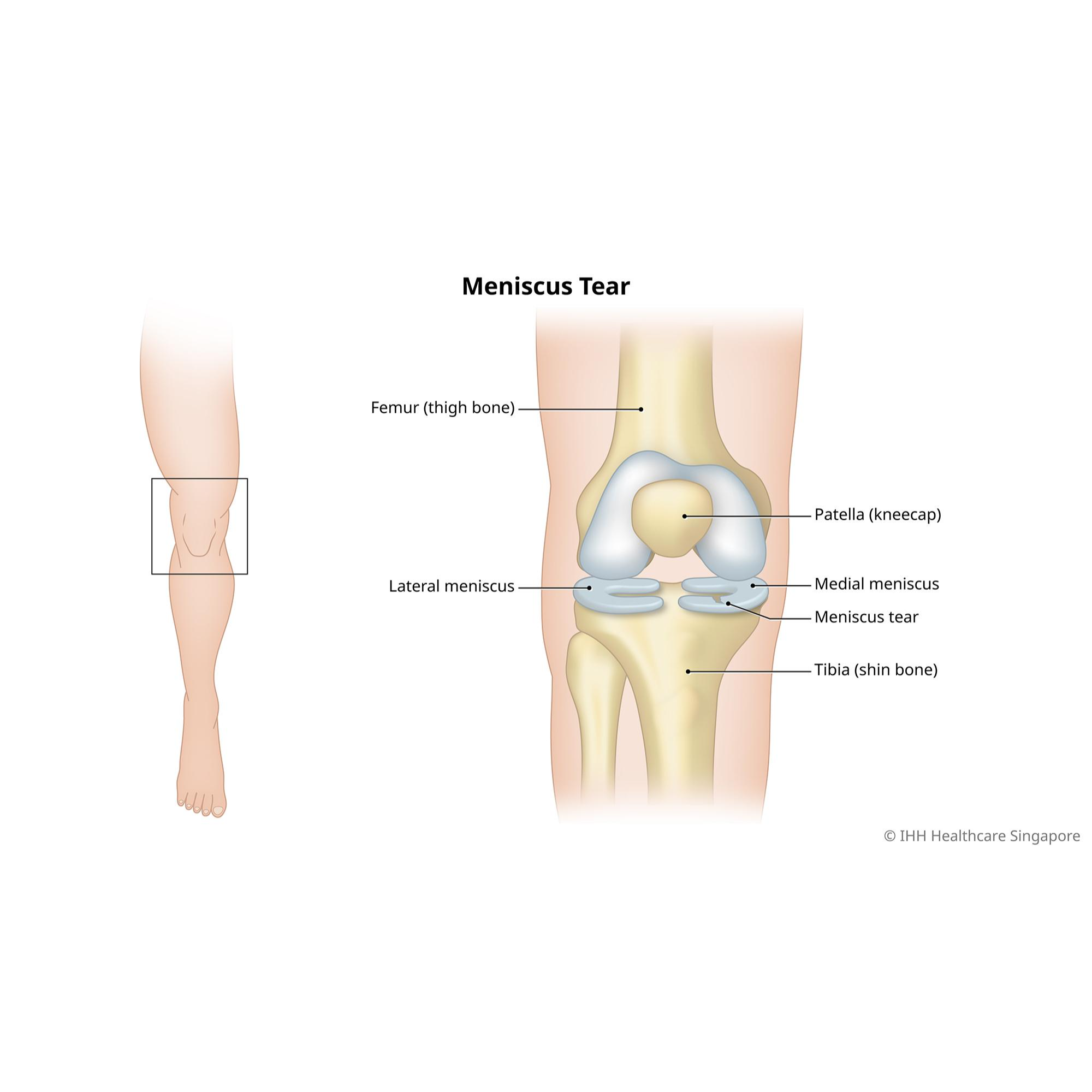 meniscal tear