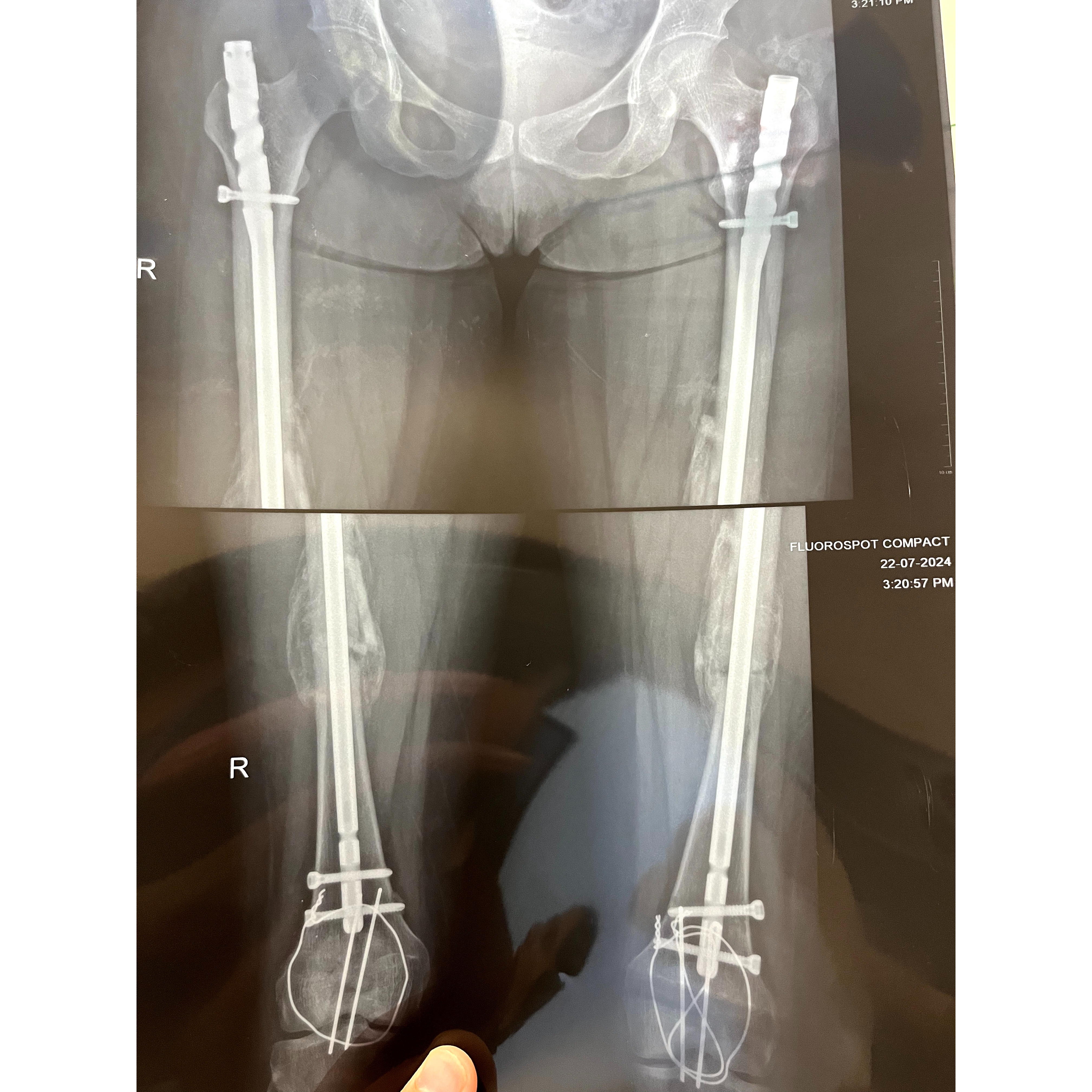 post surgical rehabilitation s