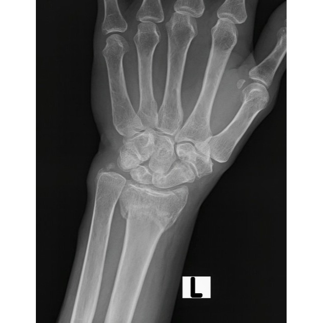 colles fracture rehabilitation