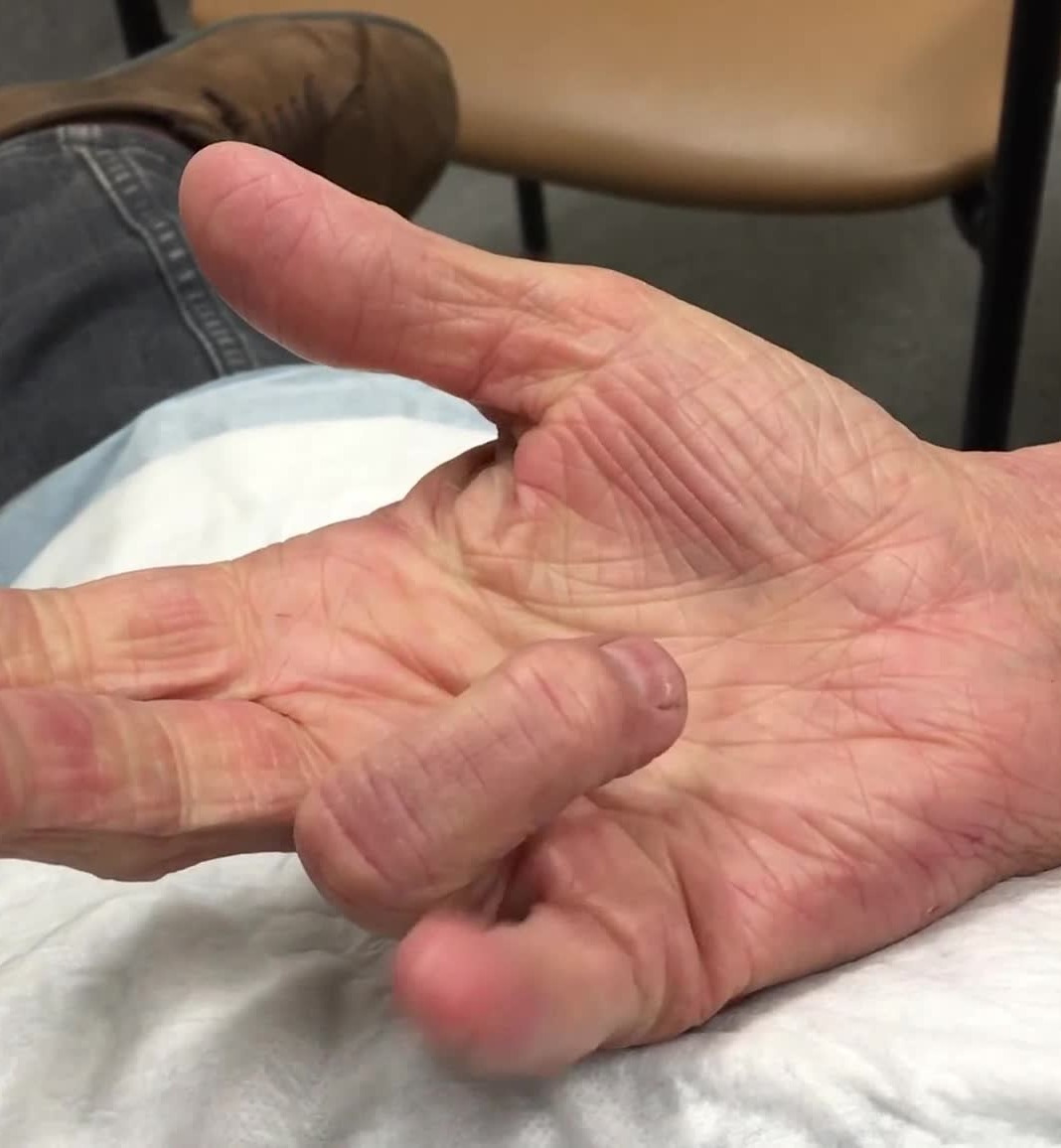 ring finger
