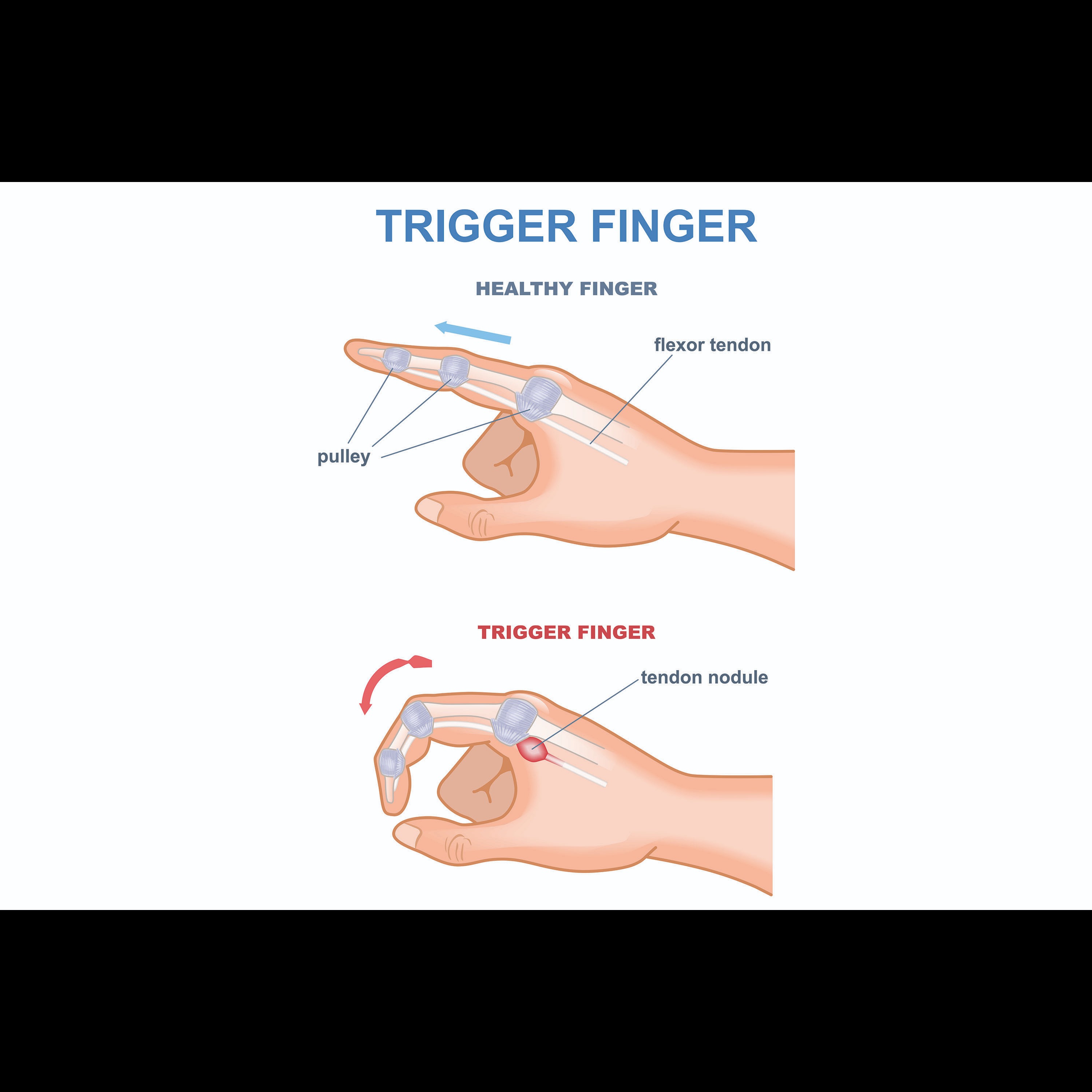 bent finger