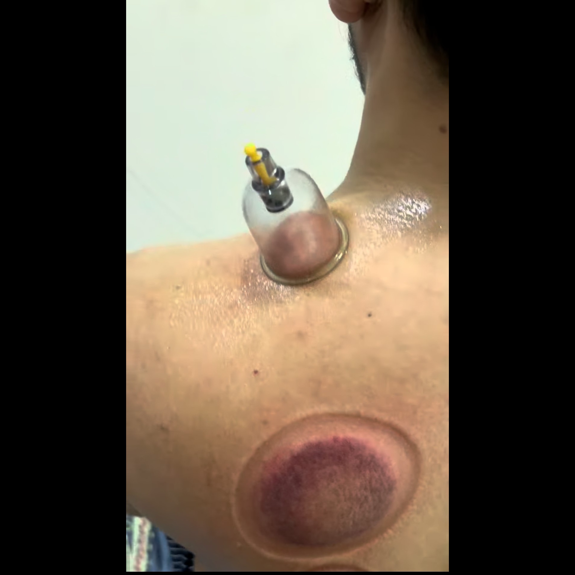 physiotherapy treatment for ce