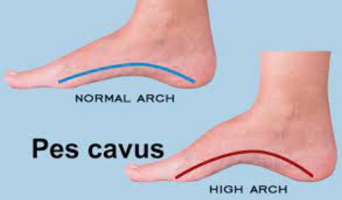 affected foot