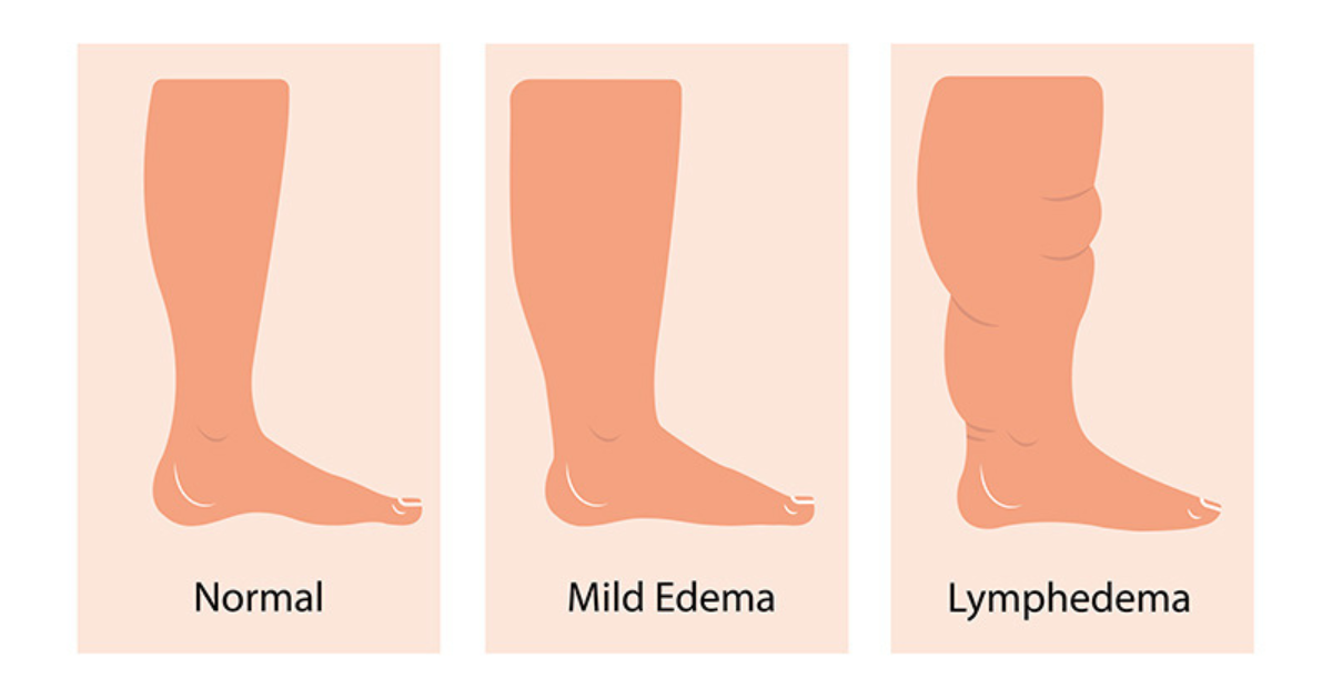 arches edema