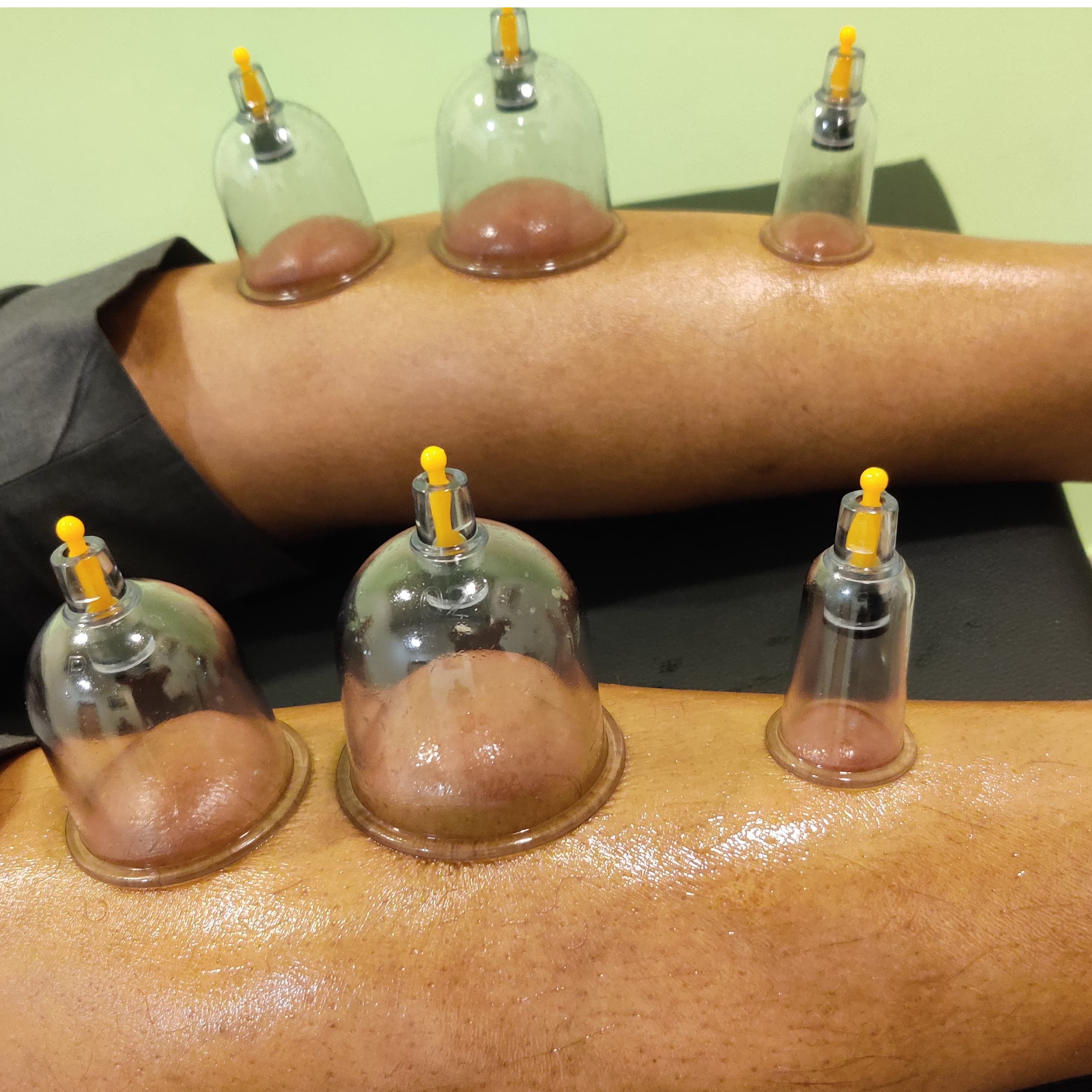 dynamic cupping therapy