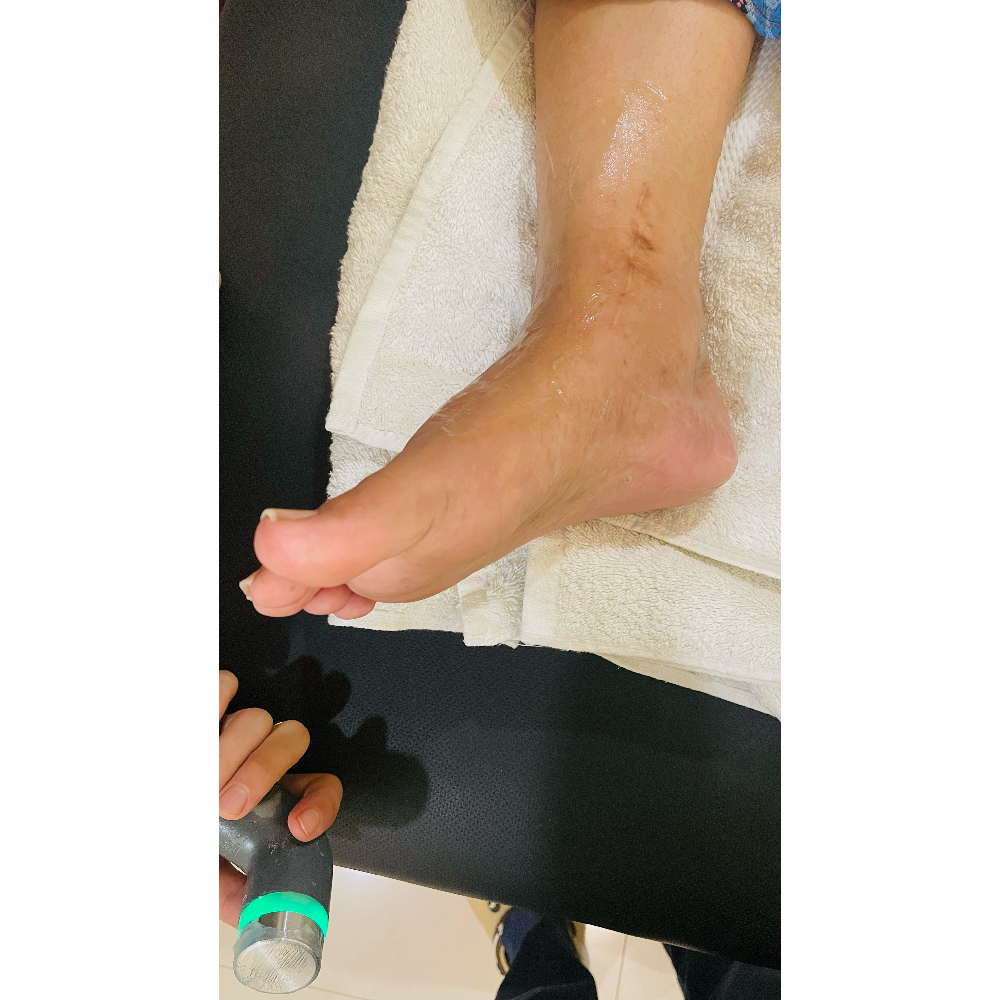 plantar fasciitis