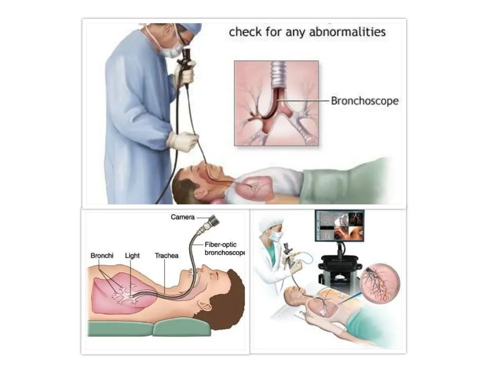 What Is Bronchoscopy?
Bronchoscopyis a procedure u...