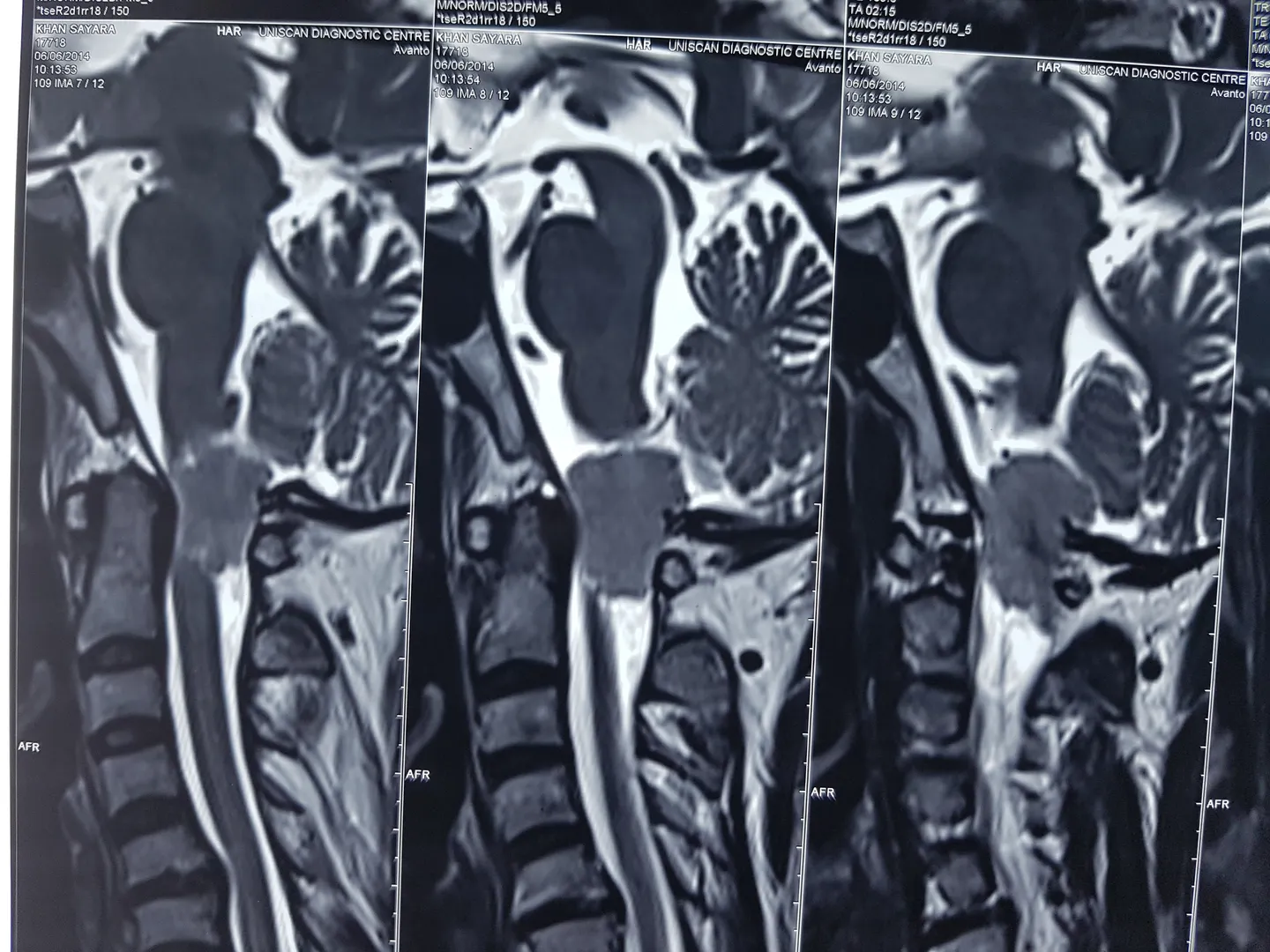 Spinal tumors are relatively common problems seen ...