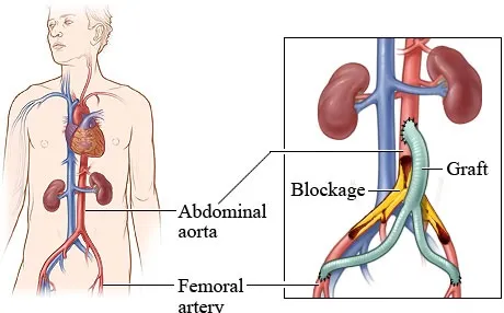 Vascular, Endovascular Surgeon in Pune
For instan...