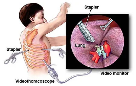 Indications for VATS
Thoracic Surgery procedures ...