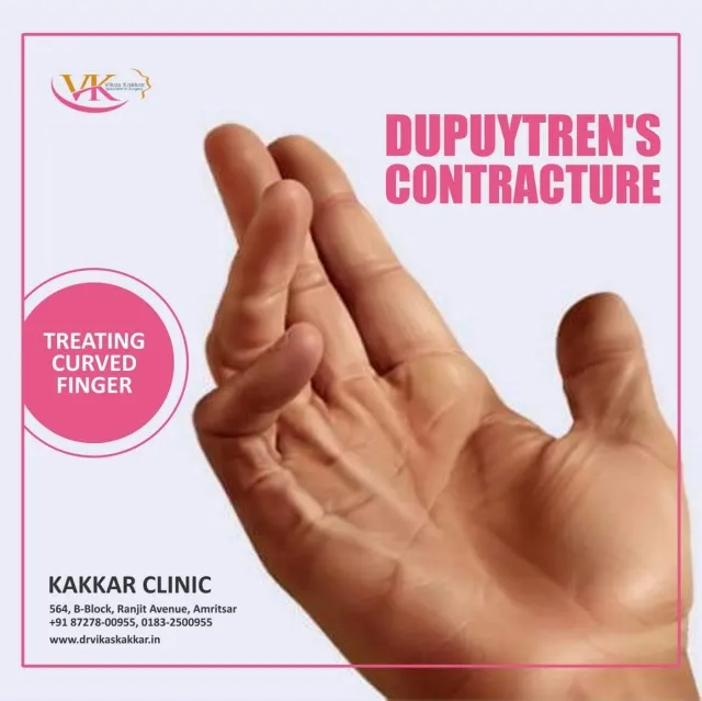Dupuytren's contracture is very disabliling condit...