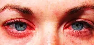 Eye Allergies
Eye allergy or allergic conjunctiv...