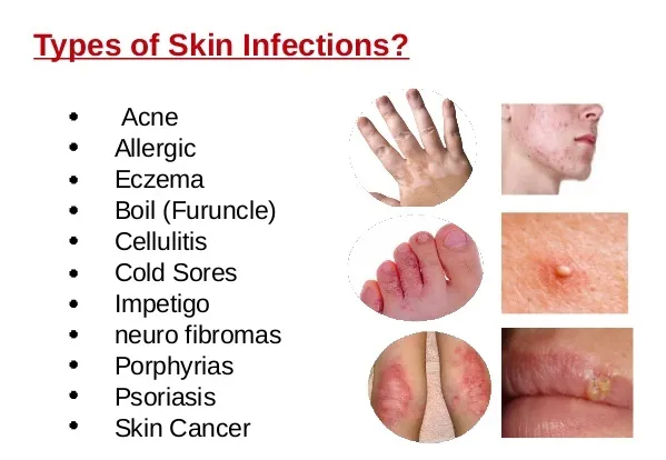 Skin Diseases
‘If you don’t bathe properly, you’ll...