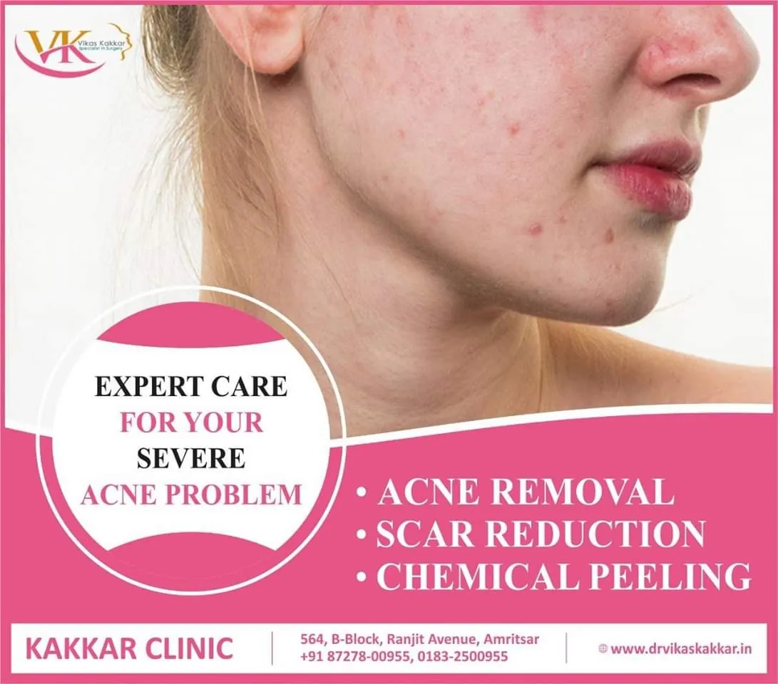 ##Expert Care#For Your #Severe Acne Problem##
##AC...