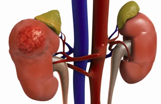 Kidney Problems
Kidney problem in early stage ha...