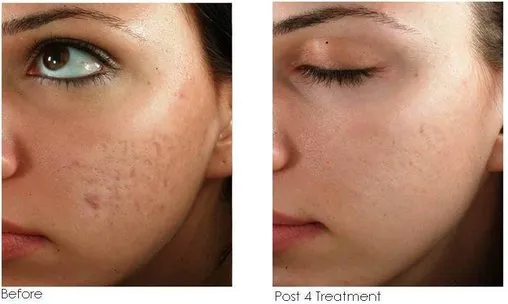MICRONEEDLING TREATMENT FOR OPEN PORES
Microneedli...