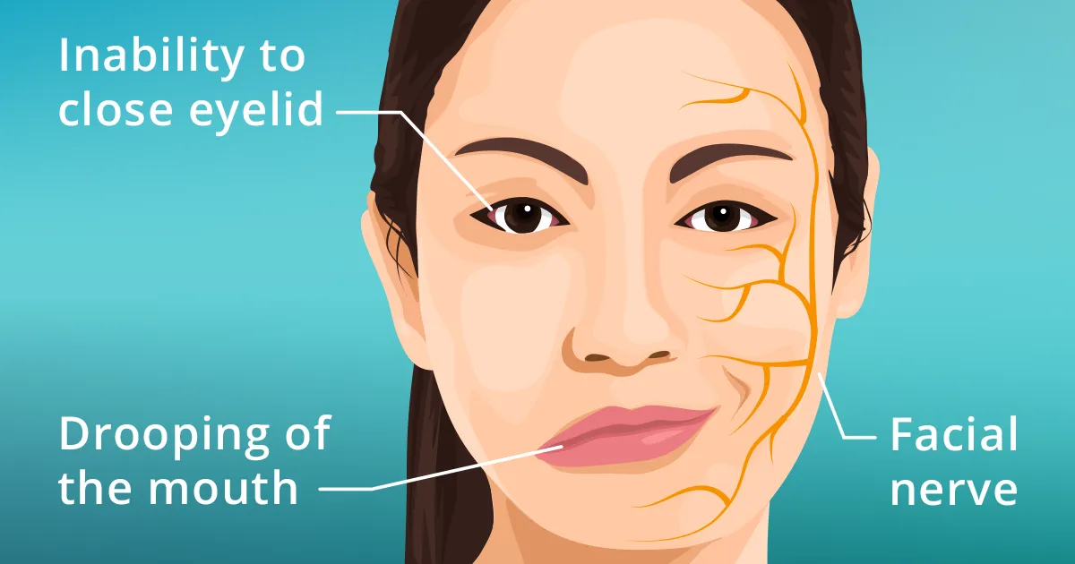 BELLS PALSY: Also called Facial Palsy
Bell's pals...